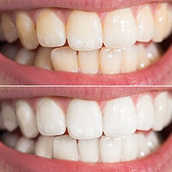 Closeup of smile before and after whitening