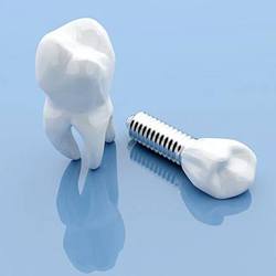 Single tooth implant on blue background