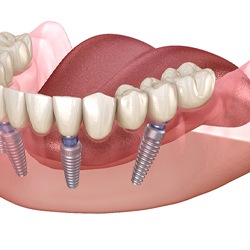 All-on-4 implant denture on lower arch