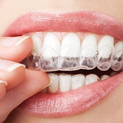 Closeup of teeth as clear aligner is placed