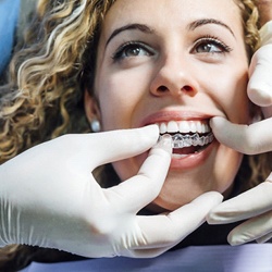 A dentist inserting an Invisalign aligner into a female patient’s mouth during her initial fitting
